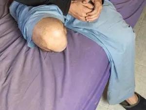 Wisconsin Nurse Amputates Patient's Leg Without Consent